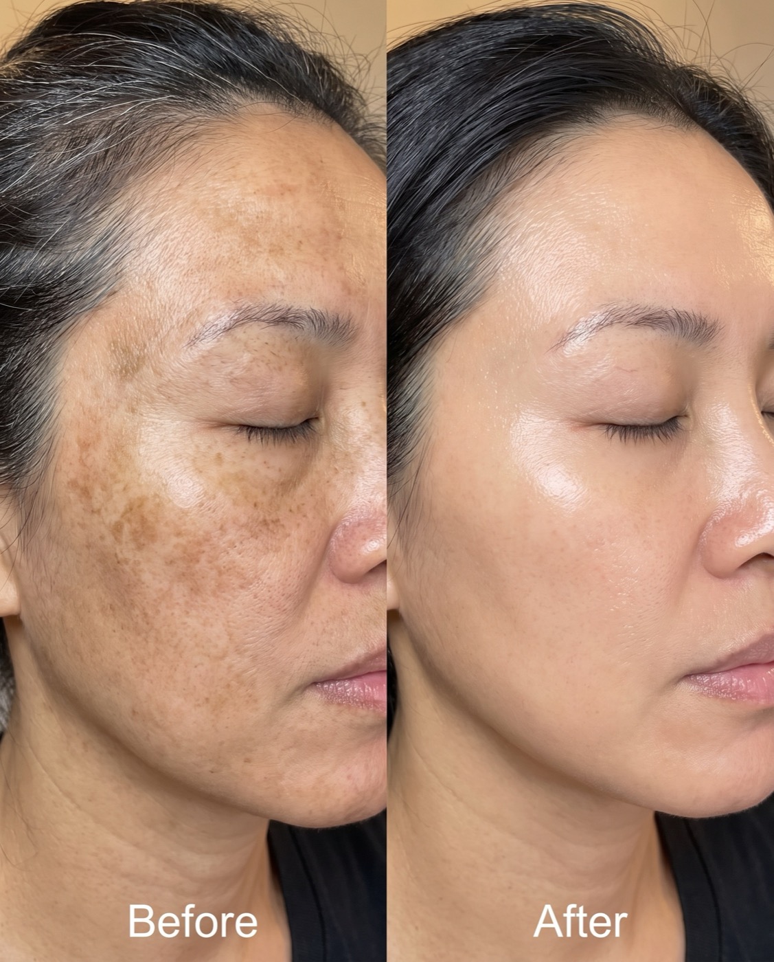 Collagen Lifting before and after, brighter and clearer skin