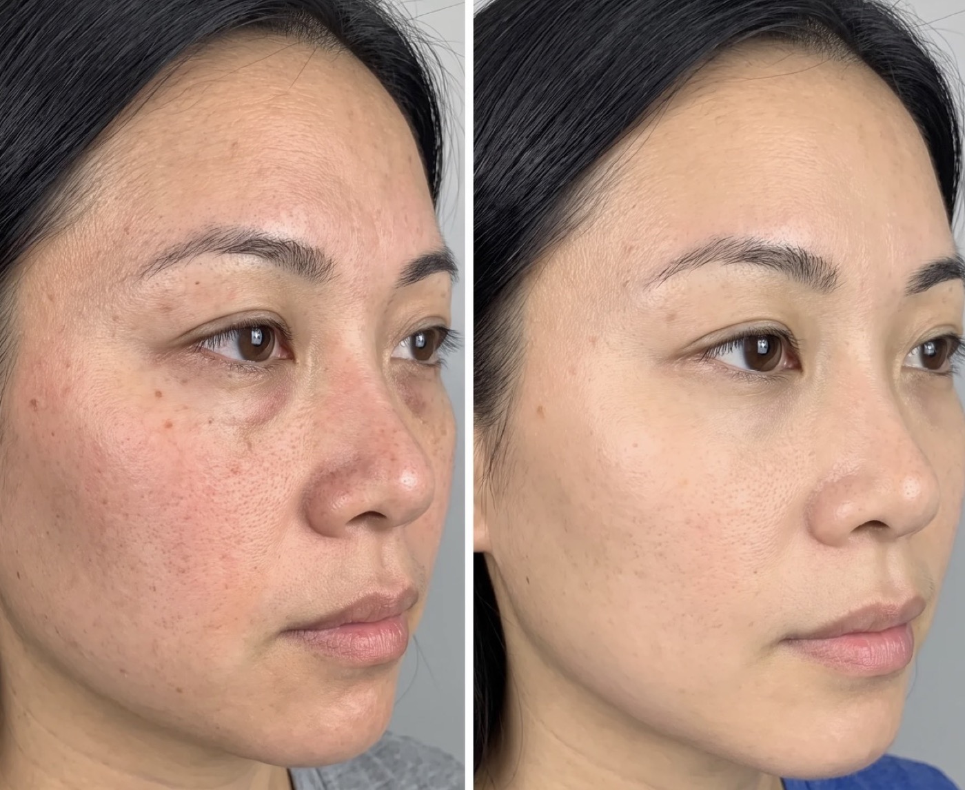 Collagen Lifting before and after, redness and evenness