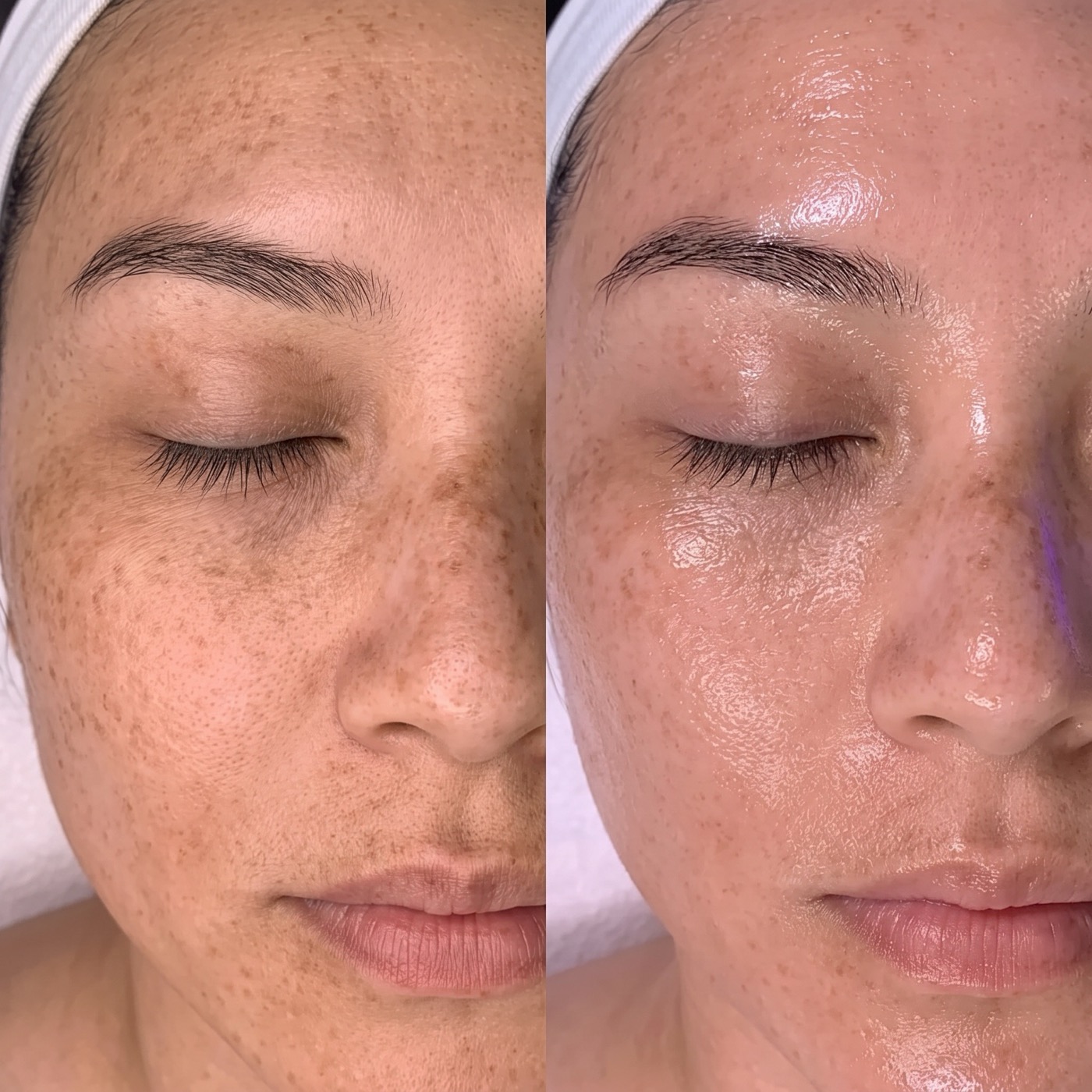 Collagen Lifting before and after, full face clarity and glow
